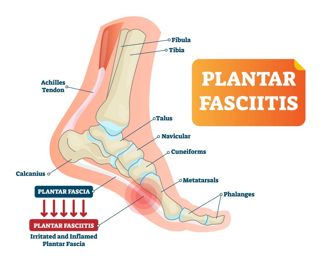 Plantar Fasciitis Explained: Causes & Relief - Colony Insoles